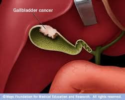 Karcinom žučne kese | Simptomi karcinoma žučne kese | Tumor
