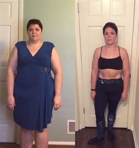 15 Captivating Weight Loss Surgery before and after Sleeve - Best ...