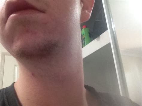 Do I Have Mild Or Moderate Acne – General acne discussion – Acne.org Forum