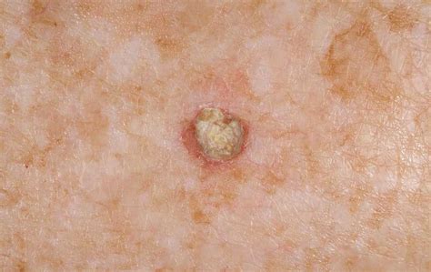 Актинична кератоза – най-честата кожна преканцероза – Medical News