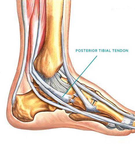 tibialis posterior tendon tenosynovite du tendon tibial posterieur