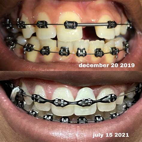 I have a pontic in currently but I was given the okay to get dental