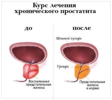 Топ-5 эффективных лекарств для лечения простатита | Урологический центр ...