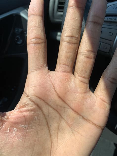 Wtf is happening to me. Is this just dry skin or should I go to the