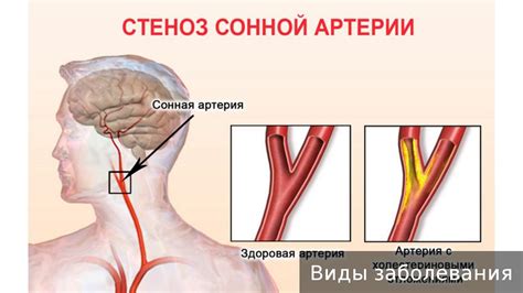 Стеноз сонной артерии. Как лечить стеноз сонной артерии. - YouTube