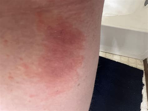 Sudden rash that’s itchy and spreading anyone have any ideas? : r