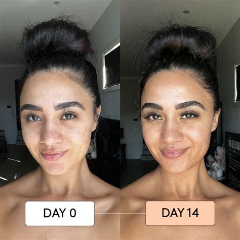 Hyperpigmentation Klairs Vitamin C Serum Before And After at Timothy ...