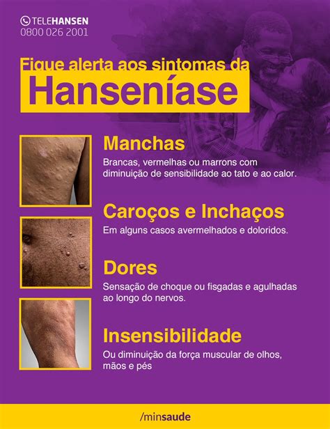 O Que Significa Hanseníase - Hanseníase: que mancha é essa? – Laboratório Gerardo Trindade