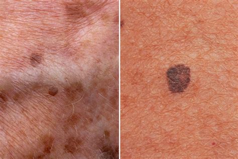 Melanoma Light Brown Spots On Skin - Infoupdate.org