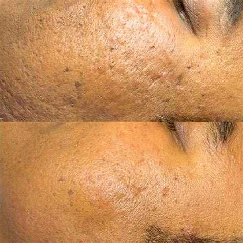 tetra  laser cool peel  enriched vaughan
