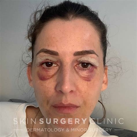 Eyelid Surgery Swelling Top Sellers | www.cumberland.org