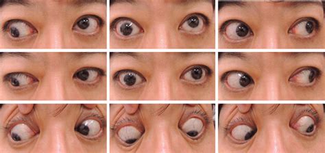 Nystagmus [SIGNS CAUSES TREATMENTS] Top Eye Doctors Near Me