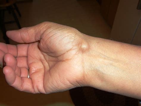 ganglion cyst  photo  flickriver