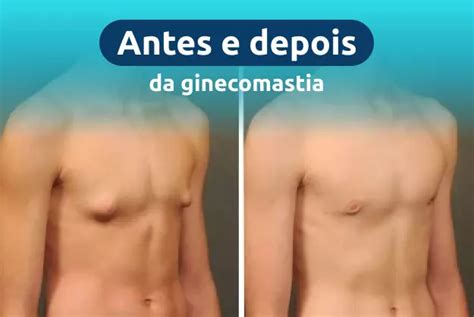 Antes E Depois Ginecomastia - Ginecomastia Antes E Depois Do Fisiculturista