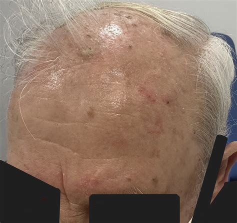 Actinic Keratosis Warning Signs and Images