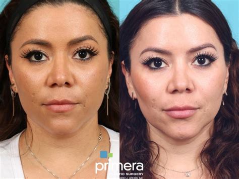 Buccal Fat Removal Before and After Photo Gallery | Orlando, Florida | Primera Plastic Surgery ...