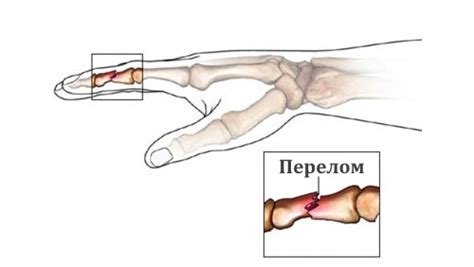 Перелом пальца на руке: симптомы, первая помощь и лечение