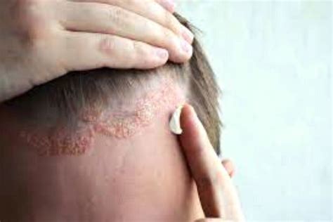 Seborrhea: Symptoms, Causes, All Remedies