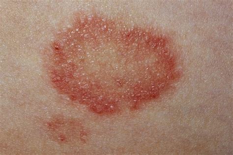 Red Ring Rash On Skin Not Ringworm