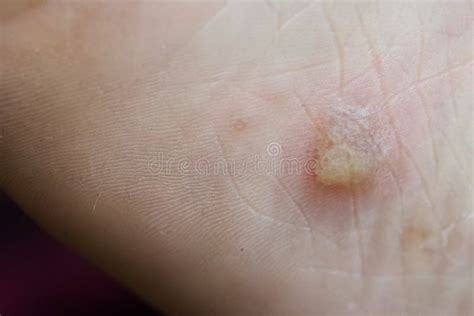 Dyshidrotic Eczema Stock Photos - Free & Royalty-Free Stock Photos from ...