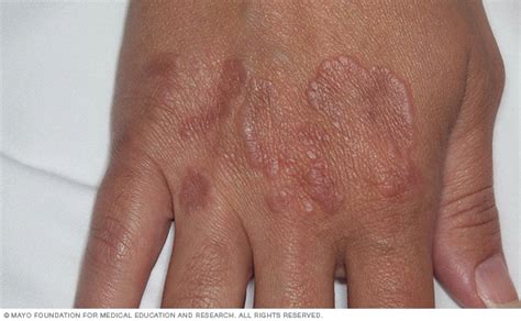 10 Common Types of Skin Rash and Treatments