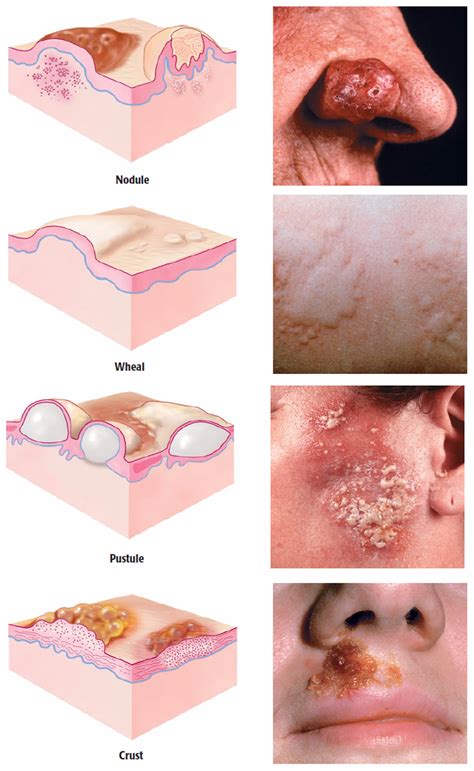 Wheal Skin Lesion