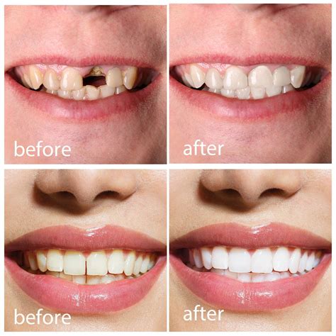 Is There A Temporary Fix For A Broken Tooth at Jose Nicoll blog