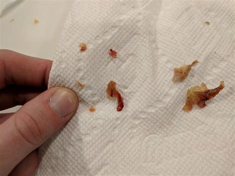 polypen bilder analfibrom ursachen symptome und behandlung ddbon