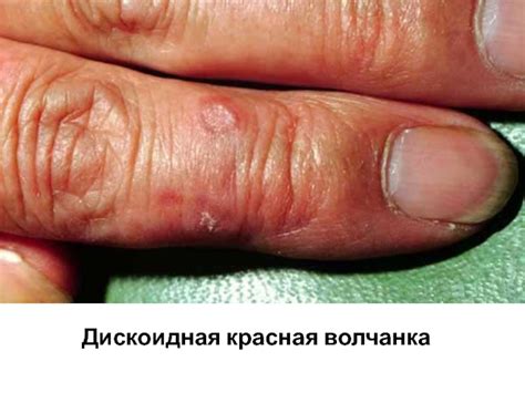 Красная волчанка
