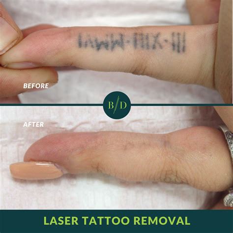 surgical tattoo removal before and after - Kazuko Gilliland