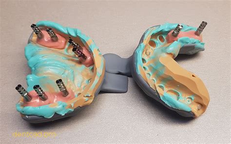 Оттискные ложки для особых случаев | Блог | DENTCAD