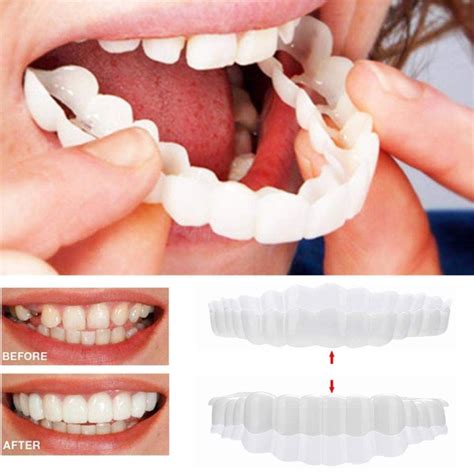 Perfect Smile Veneers - Uprara.com | Veneers teeth, Perfect smile teeth ...
