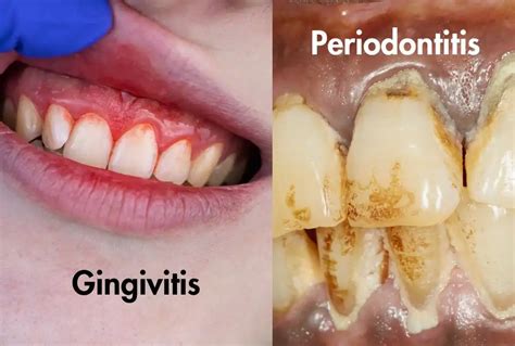 Gum Disease (Gingivitis and Periodontitis) | Signature Smilez