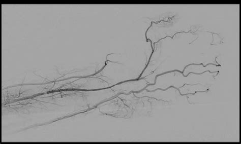 case report  persistent median artery compression syndrome ospublishers