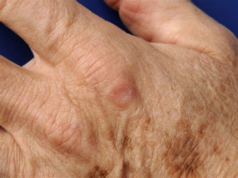 Granuloma Anular Perfurante