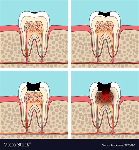 Dental caries stages Royalty Free Vector Image