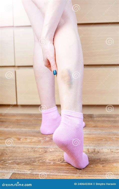 Bruised leg stock photo. Image of body, people, purple - 240643304