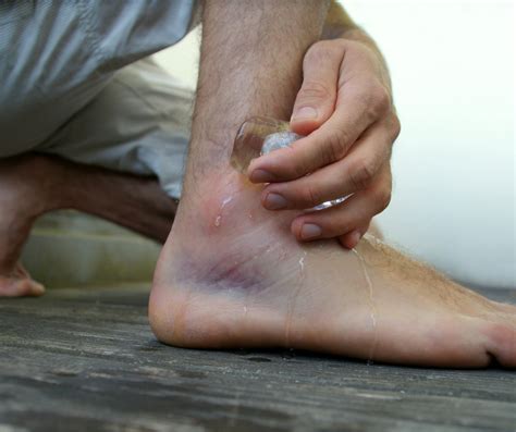 Minor Sprained Ankle