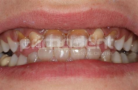 :: PrimaDent