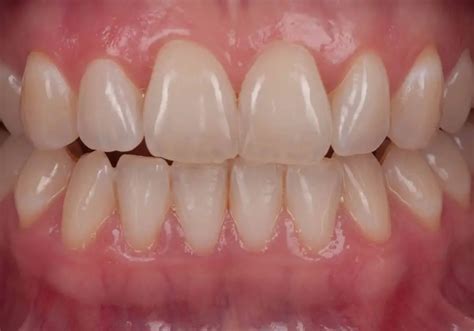 Can You Fully Remineralize Teeth? (Ultimate Guide)