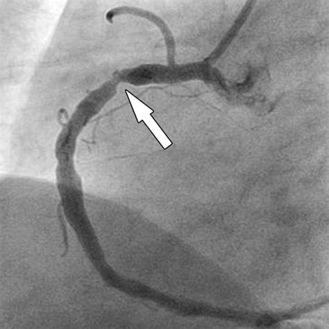 Dual-Source versus 64-Section CT Coronary Angiography at Lower Heart