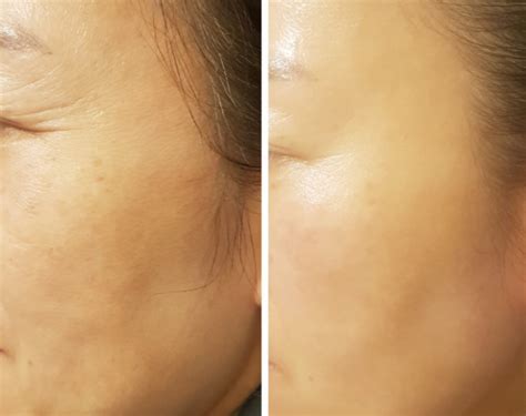 Exosomes | My Bliss Clinic