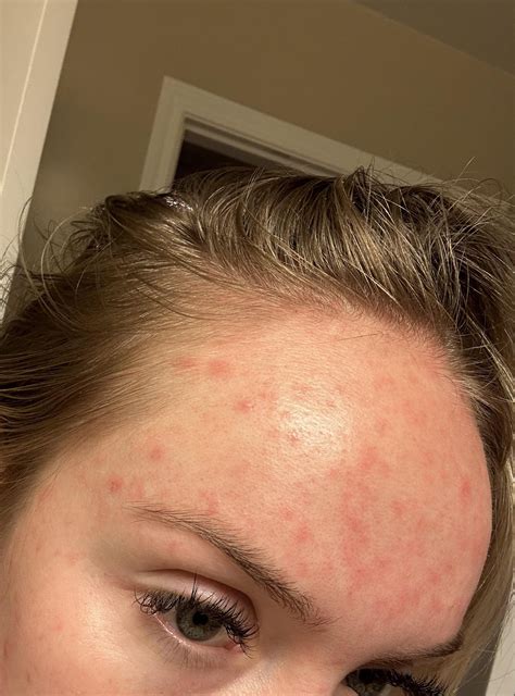 amoxicillin rash? : r/Dermatology