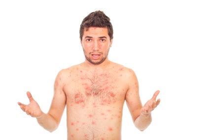 kena cacar air  dewasa bisa lebih berbahaya