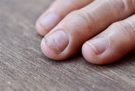 Unaesthetic nail lines: why do they occur? Can they be prevented ...