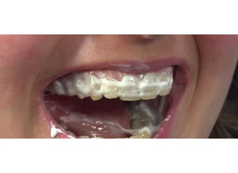Tooth Mousse Тусс Мусс GC – купить в Алматы с доставкой по Казахстану ...
