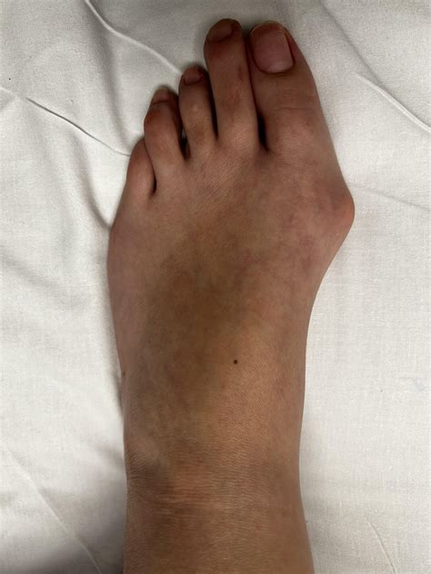 ProStep Minimally Invasive Bunion Surgery : r/bunions