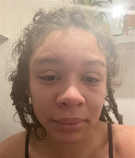 Woman rushes to A&E after mystery extreme allergic reaction sees her