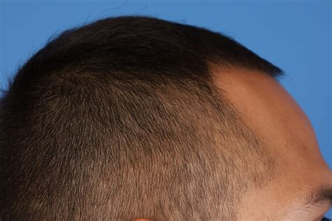 Hair Restoration - Taylor Plastic Surgery