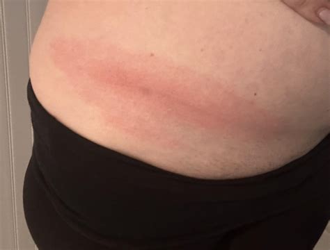 Off to urgent care cause I’m freaking out over this : r/lymedisease